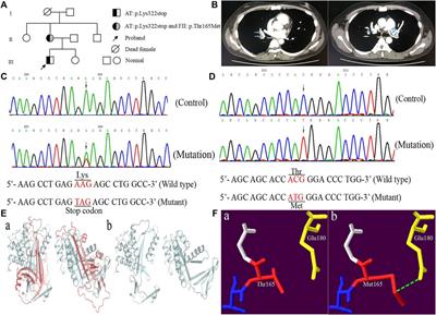 Genetic Analysis of a Pedigree With Antithrombin and Prothrombin Compound Mutations and Antithrombin Heterozygotes